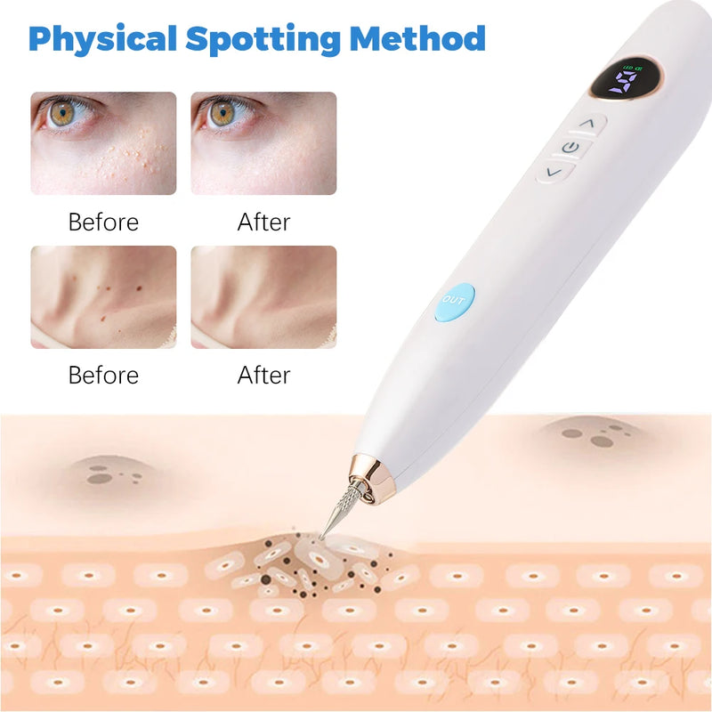 Caneta Jato de Plasma Digital - Remova Manchas, Verrugas e Muito Mais!